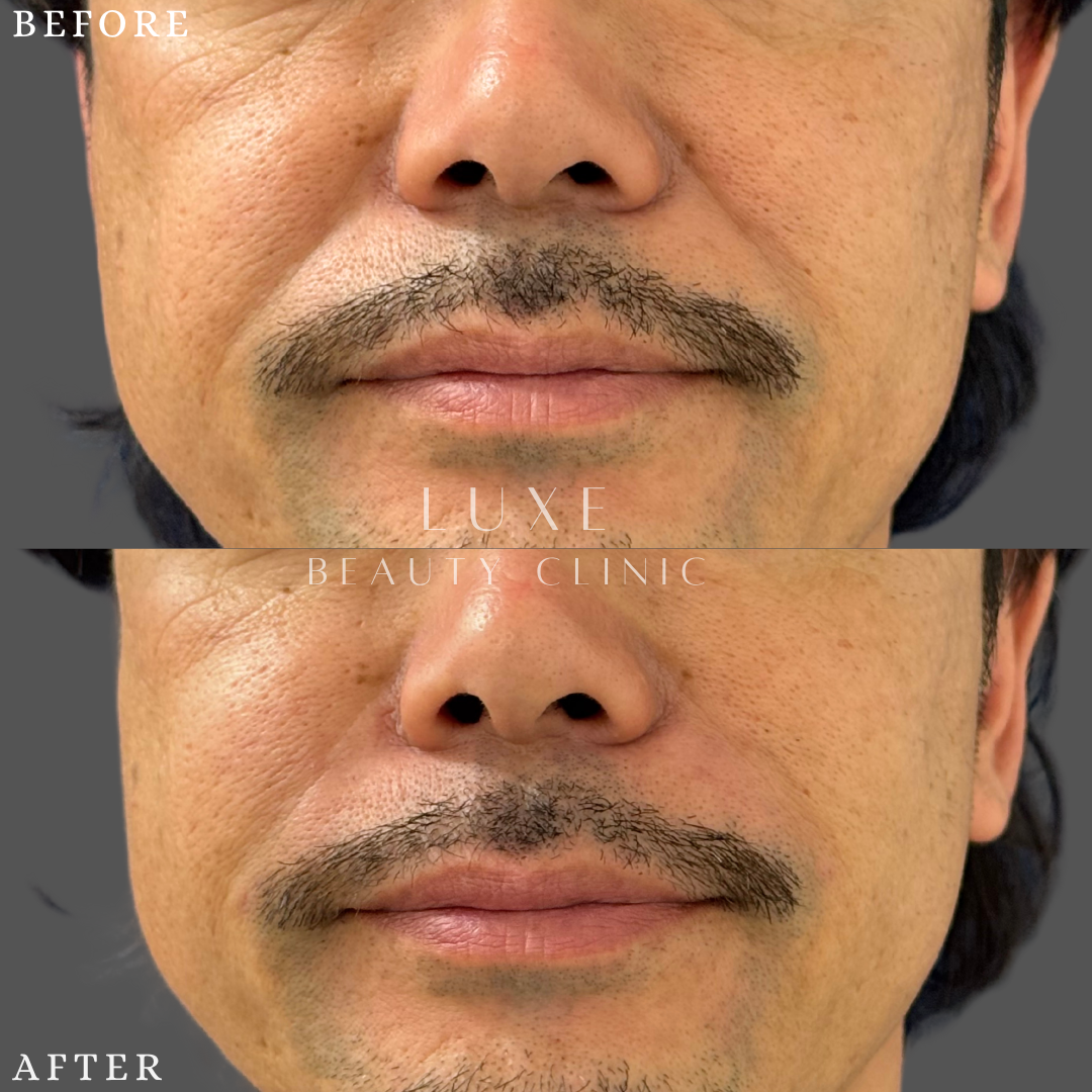 ヒアルロン酸注入　法令線